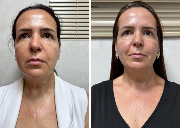 Fotona 590 x 420 f4d 01