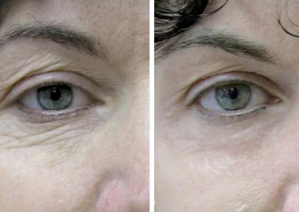 Fotona 590 x 420 f4d 03