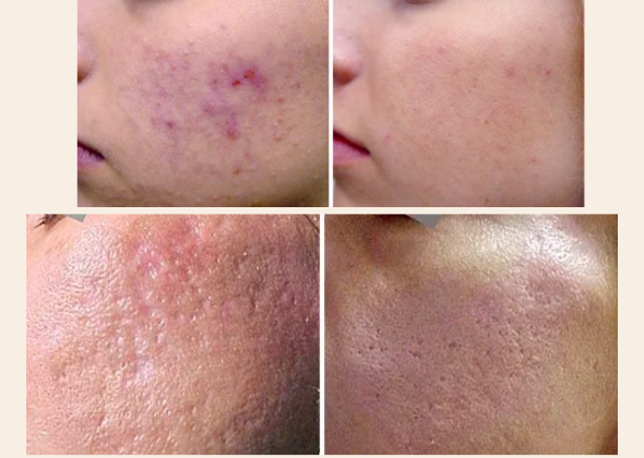 Fotona 590 x 420 f4d 05